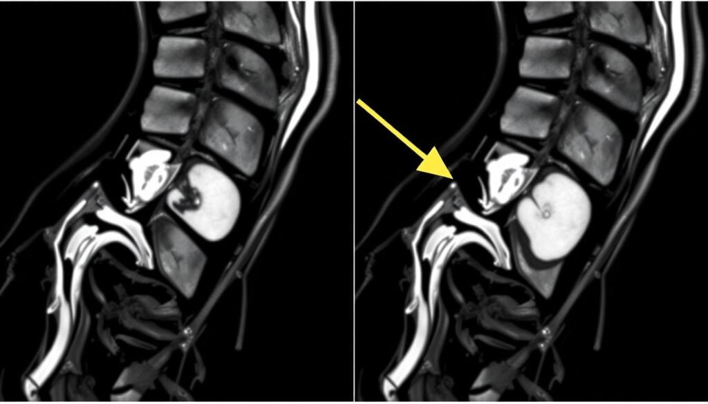 MRT-Aufnahme eines Bandscheibenvorfalls